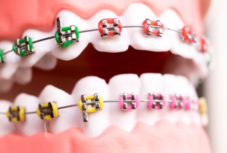 Power Chain Colors: What Color Makes Teeth Look Whitest?